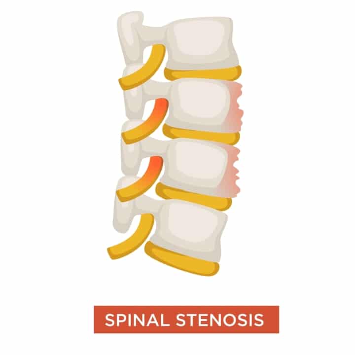 Best Shoes For Spinal Stenosis