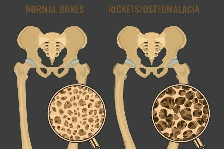 Difference between Osteoporosis and Osteomalacia