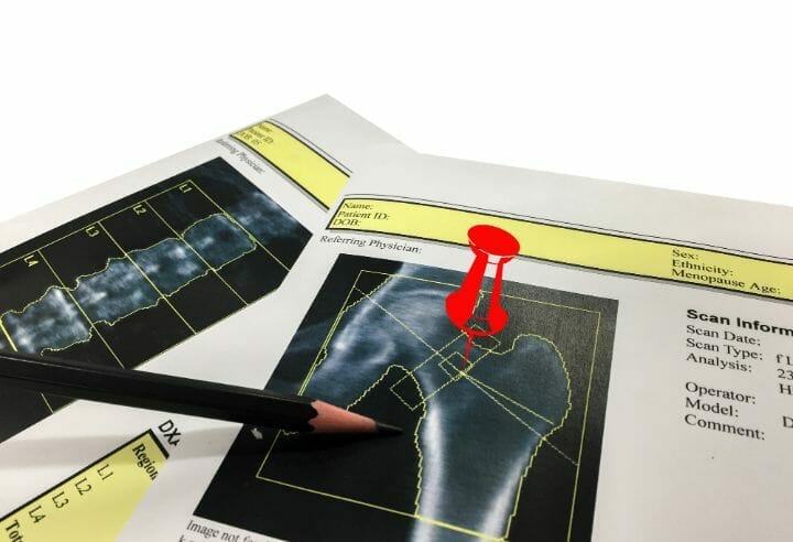 BMD hip scan