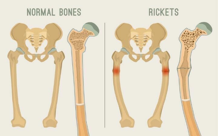 Osteoporosis and Osteomalacia