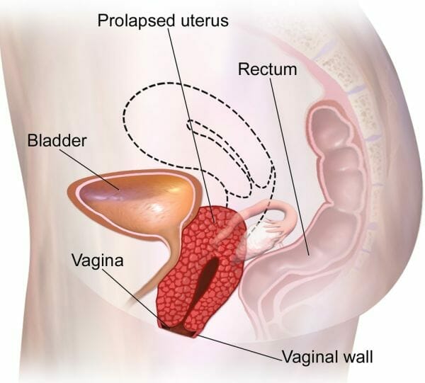 A diagram showing uterine prolapse