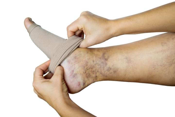 using compression socks for varicose veins