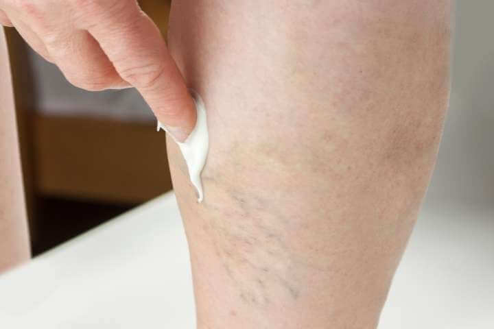 varicose veins cream