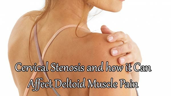 Cervical Stenosis and how it Can Affect Deltoid Muscle Pain