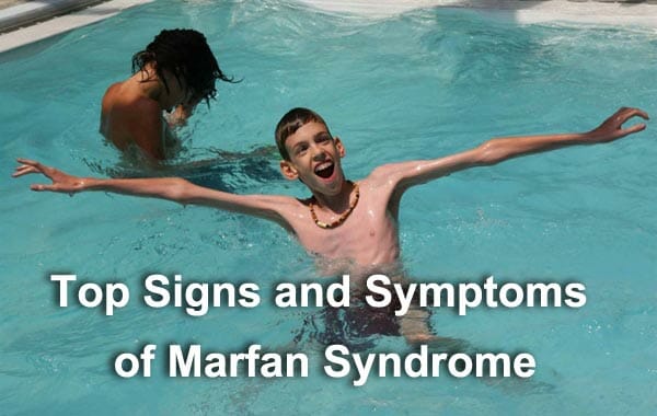 Top Signs and Symptoms of Marfan Syndrome