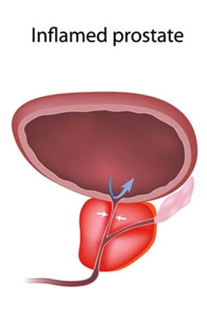 What is the Length of Prostatitis Flare Ups