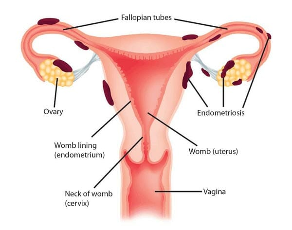 endometriosis pain relief