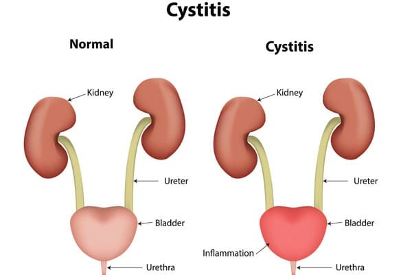 Interstitial Cystitis and Bladder Pain
