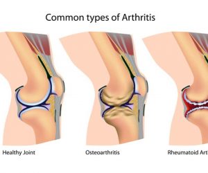 Arthritis Remedies: 3 Natural Ways to Fend Off the Pain