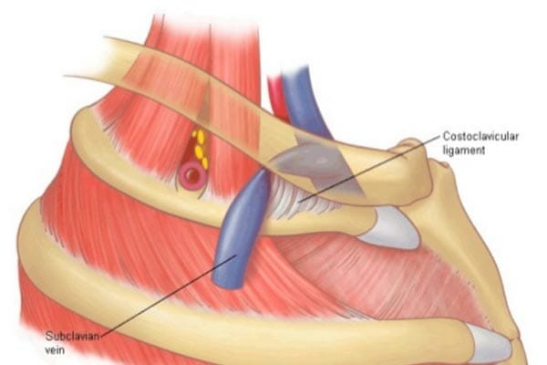 What is Costoclavicular Syndrome