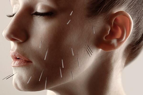 acupuncture for tmj