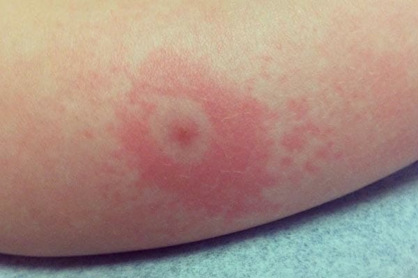 is lyme disease curable