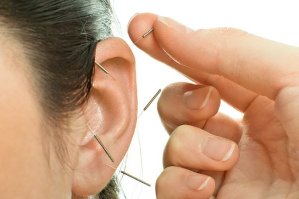 Acupuncture For Tinnitus