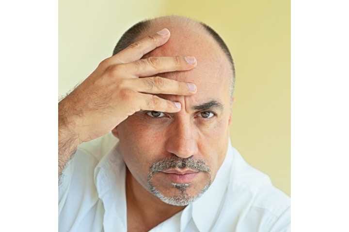 Managing Hair Loss With Age