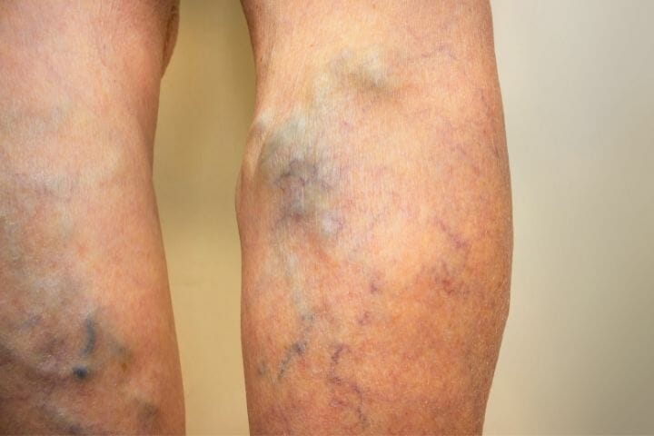 Taking Care of Varicose Veins As You Age