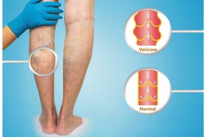 Taking Care of Varicose Veins As You Age