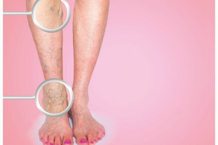 Taking Care of Varicose Veins As You Age