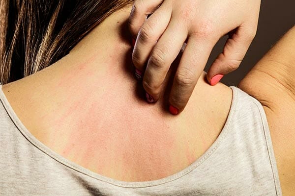 Fibromyalgia Allodynia