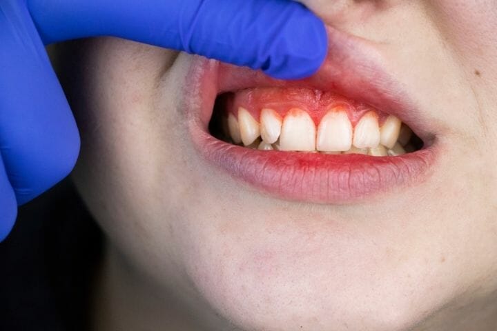 Does Gum Disease Impact the Heart?