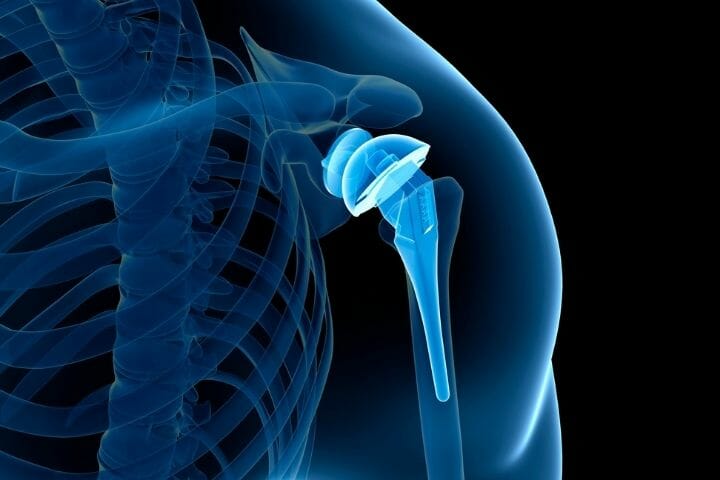 Caregiver's Guide to Managing Shoulder Replacement Patients