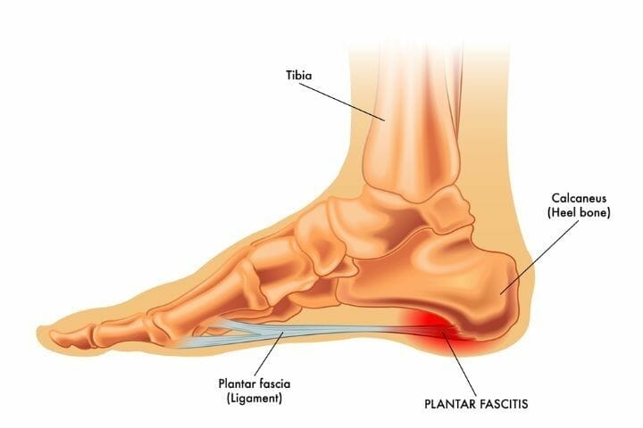 Can Plantar Fasciitis Cause Hip Pain