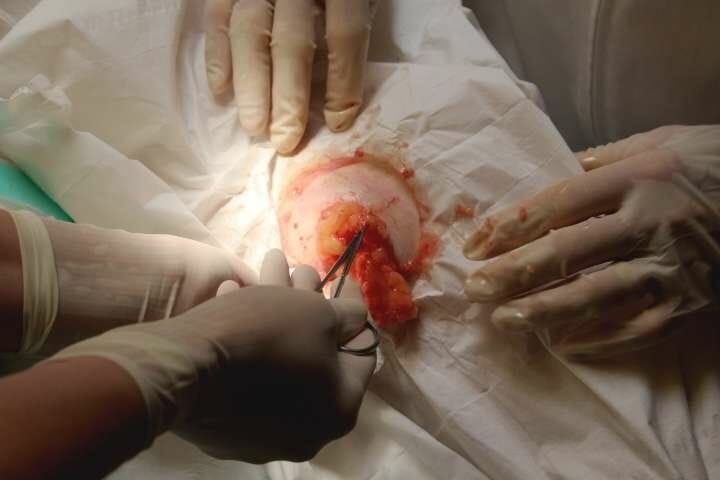 Lipoma removal