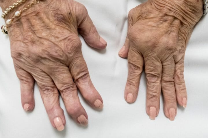 Is Rheumatoid Arthritis A Disability