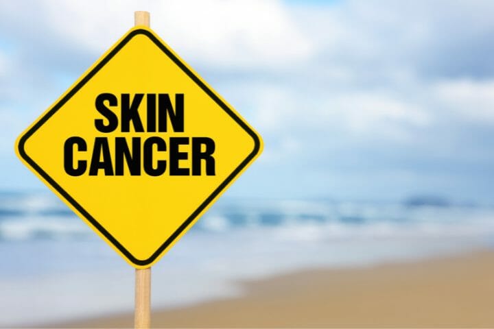 Can You Get Disability For Skin Cancer