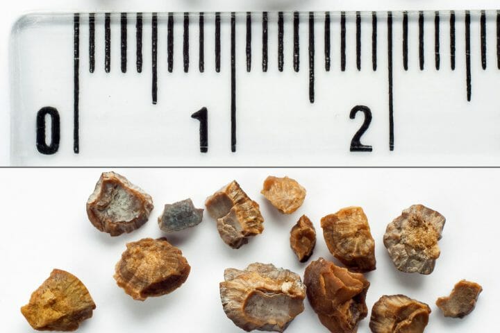 Can You Get Disability For Kidney Stones