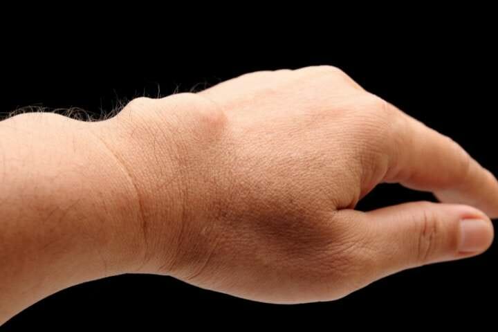 cyst on wrist