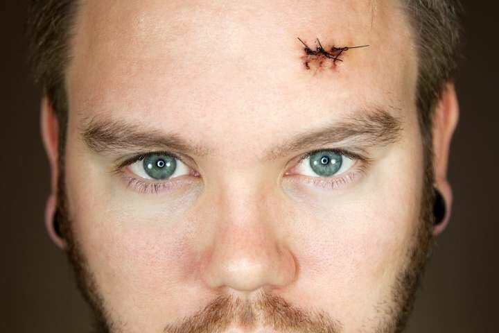 man with stitch on forehead