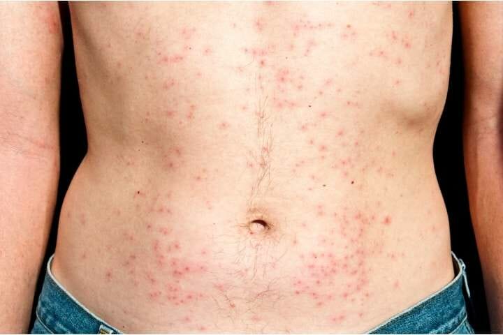 Folliculitis