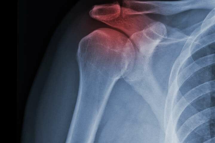 shoulder fracture