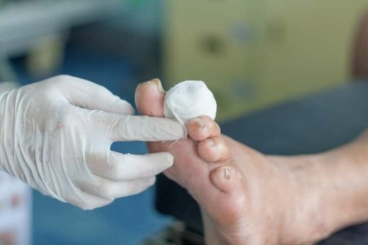 treating wounded foot